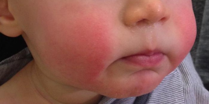 Schematic diagram of the Slapped Cheek Syndrome - Dr Yeung Ho Hong 楊浩康