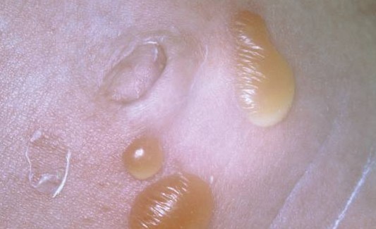 Dr. Yeung Ho Hong(楊浩康) explains What is impetigo